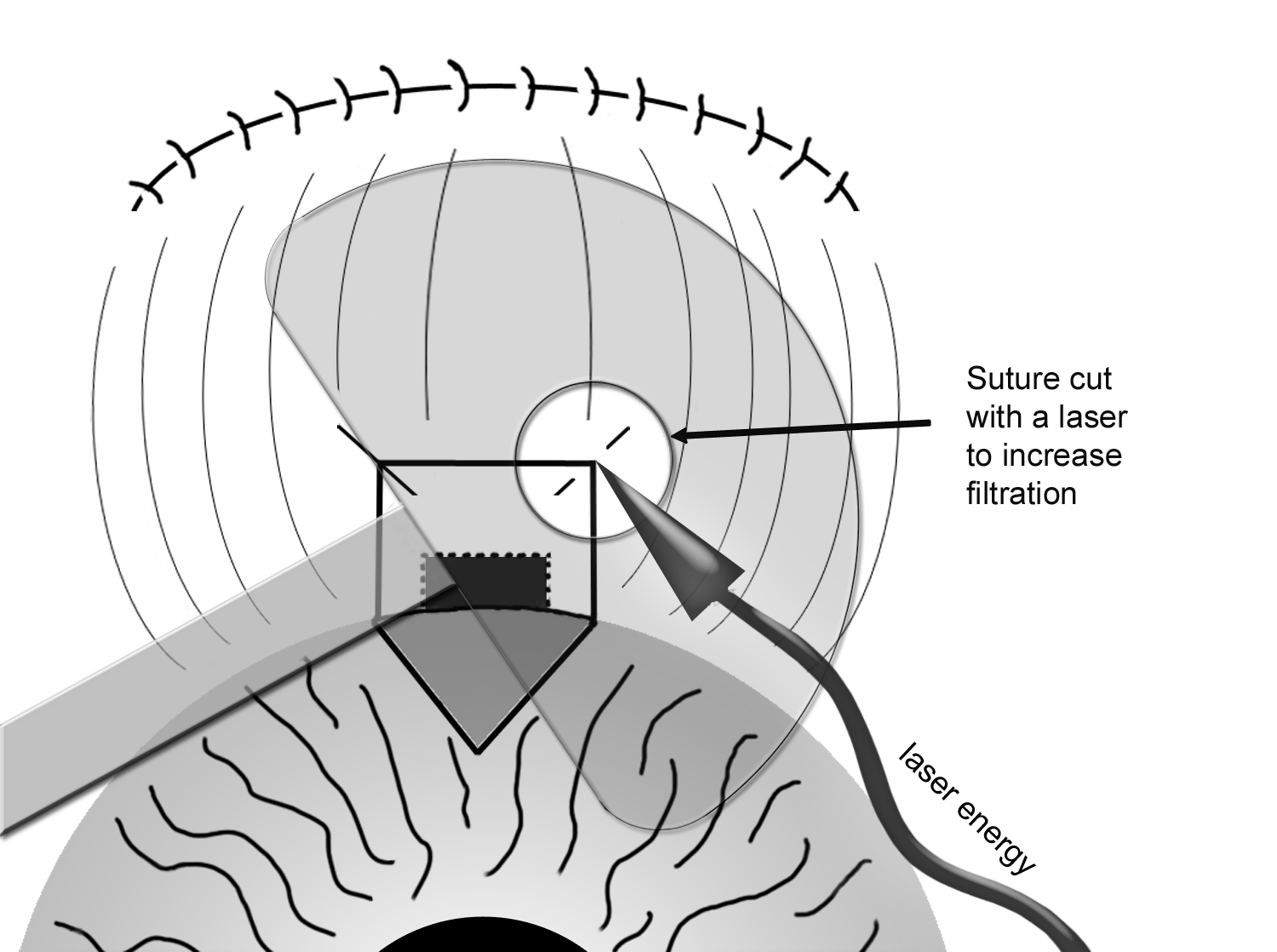 Post-op laser suturelysis